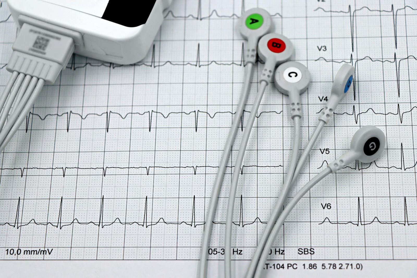 detailed ecg leads on heart monitor printout